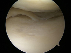 Meniscus Tear before