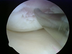 picture of microfracture injury