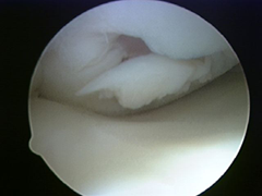 picture of microfracture injury