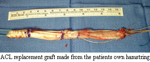 ACL replacement graft made from the patient's own hamstring tissue