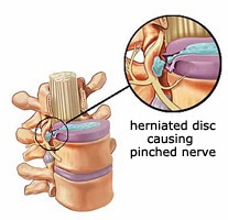 Herniated disc causing pinched nerve