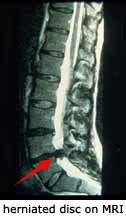 Herniated disc on MRI