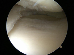 Meniscus Tear after