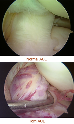 Arthroscopic photos of normal vs. torn ACL