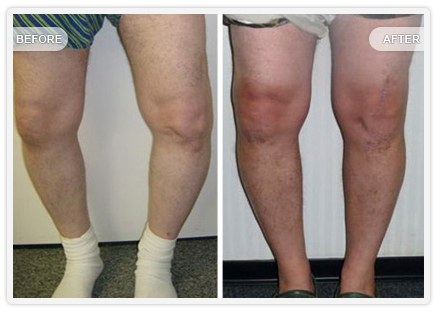 Severe bowleg deformity due to advanced osteoarthritis of the knee