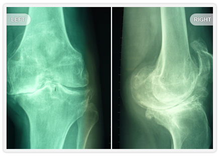 X-ray of bowleg deformity