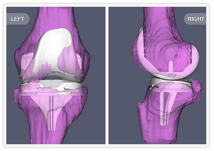 Computer generated image of knee bones with knee replacement