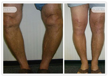 Bowleg 2 deformity