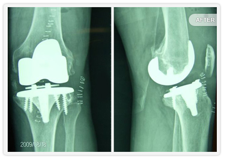 Computer generated image 2 of knee bones with knee replacement