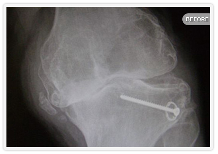 X-ray 2 of bowleg deformity