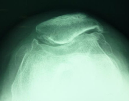 Patellofemoral Joint Replacement