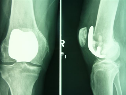 Patellofemoral Joint Replacement