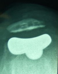 Patellofemoral Joint Replacement