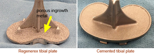 porous implant