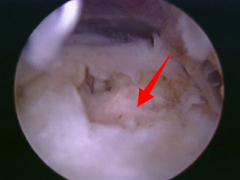 rotator cuff tear