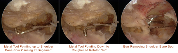 rotator cuff tear