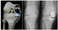 X-Ray Showing Oxford Knee Replacement