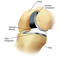 Oxford Unicompartmental knee replacement system