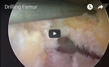 drilling-femur