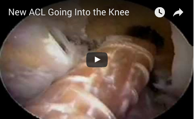 new-acl-into-knee