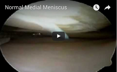 normal-medial-meniscus