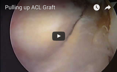 pulling-up-acl-graft