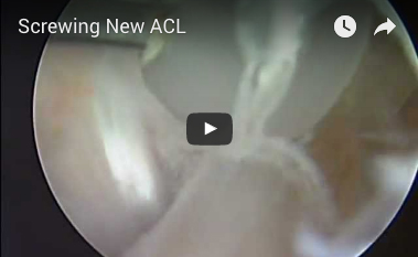 screwing-new-acl