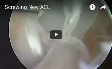 screwing-new-acl
