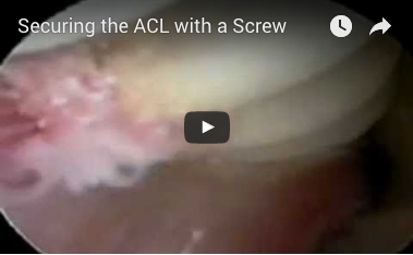 securing-acl-with-screw