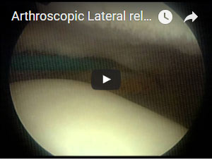 Arthroscopic Lateral release of the Patella (kneecap)