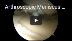 Arthroscopic Meniscus Correction Surgery