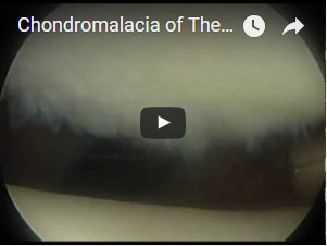 Chondromalacia of The Patella (Kneecap) Chondroplasty (arthroscopic shaving)