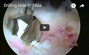 Drilling Hole in Tibia