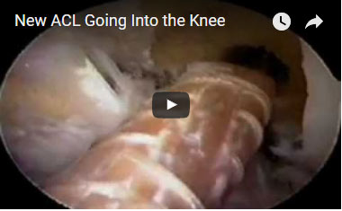 New ACL going into Knee