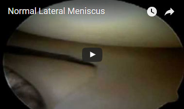 Normal Lateral Meniscus