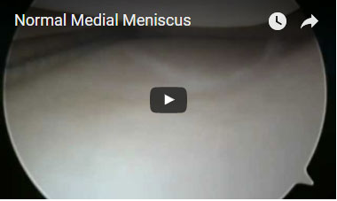Normal Medial Meniscus