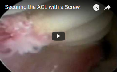 Securing the ACL with a dissolving Screw