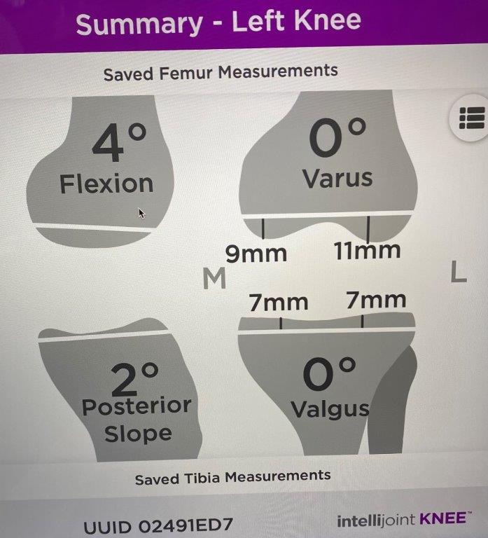 Image of how a surgeon aligns knee in all planes with Intellijoint