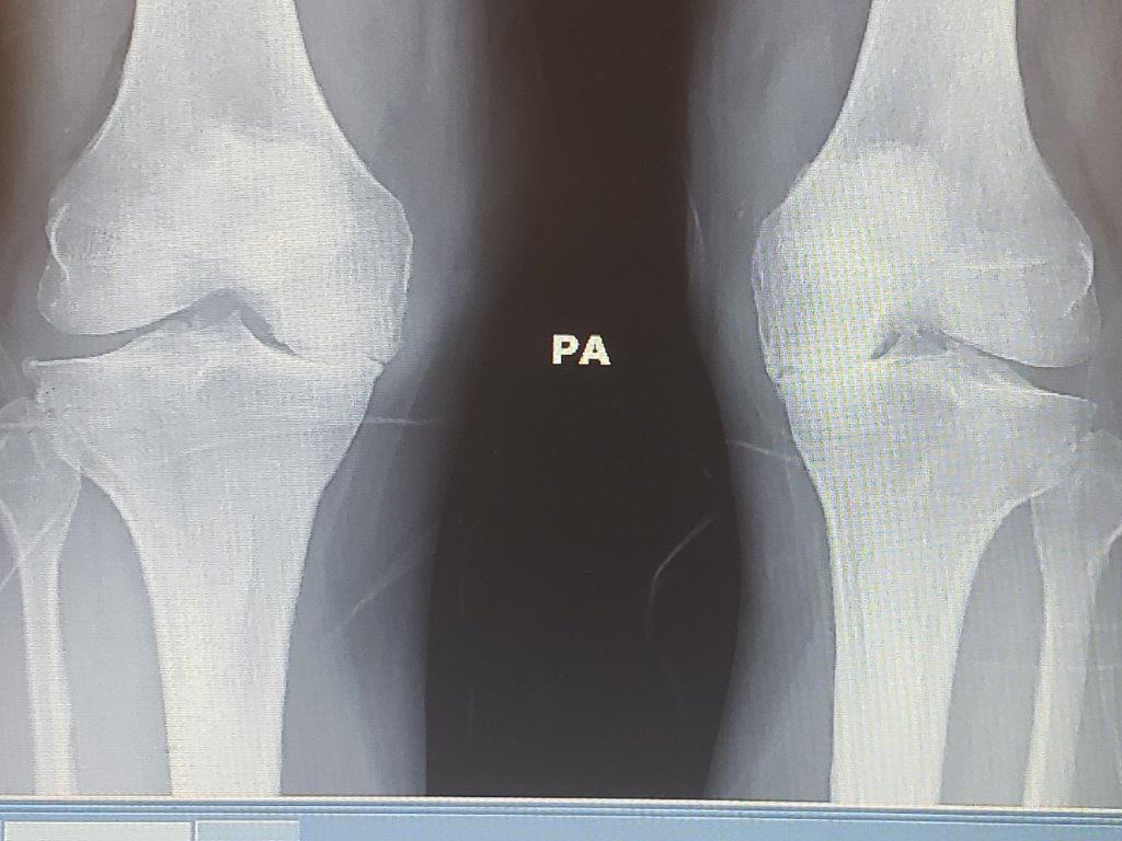 Image of what bone on bone arthritis looks like on a knee